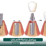 مراحل زراعة الأسنان