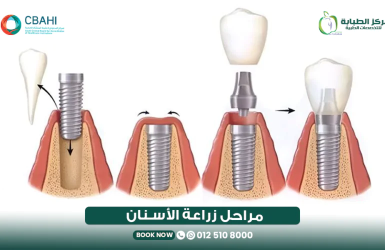 مراحل زراعة الأسنان خطوة بخطوة: من الفحص حتى تركيب السن النهائي 23 مراحل زراعة الأسنان