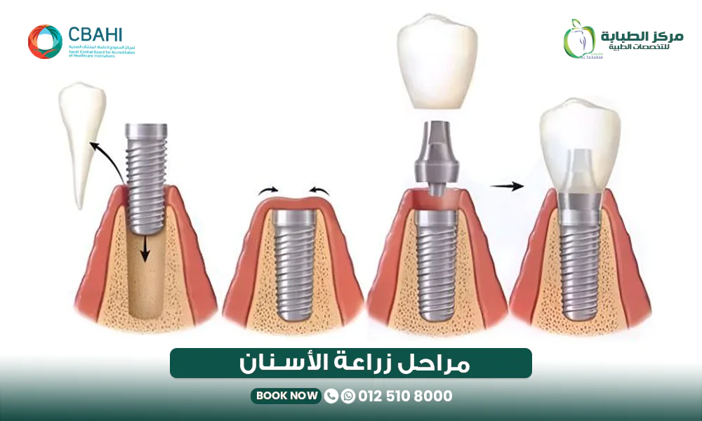 مراحل زراعة الأسنان