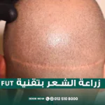 زراعة الشعر بتقنية FUT