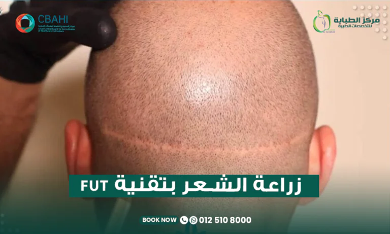 زراعة الشعر بتقنية FUT