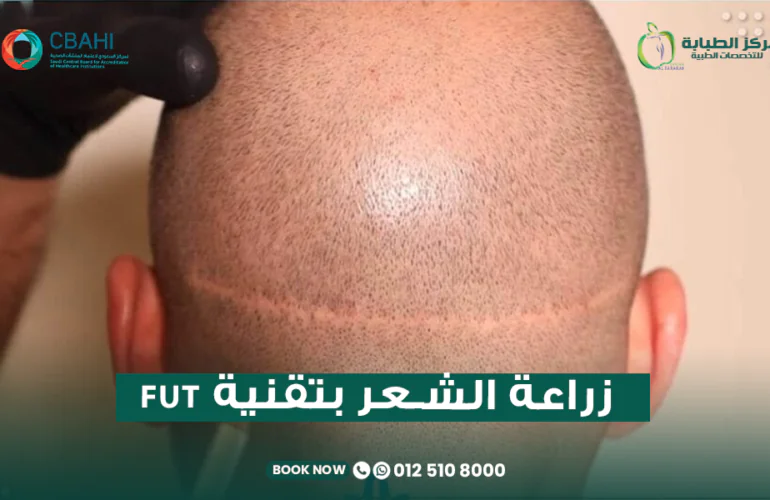 زراعة الشعر بتقنية FUT
