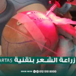 زراعة الشعر بتقنية ARTAS
