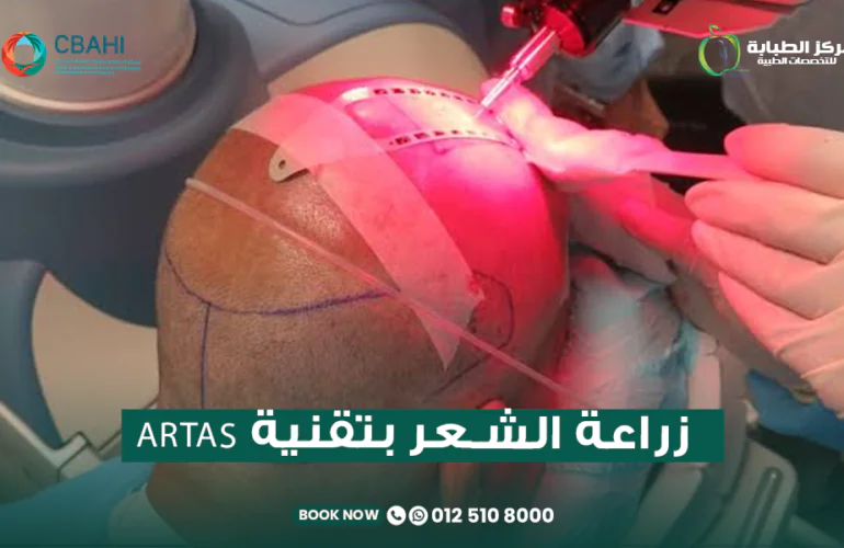 زراعة الشعر بتقنية ARTAS