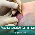 هل زراعة الشعر مؤلمة