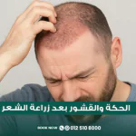الحكة والقشور بعد زراعة الشعر في مركز الطبابة في جدة
