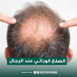 علاج الصلع الوراثي المبكر عند الرجال في مركز الطبابة