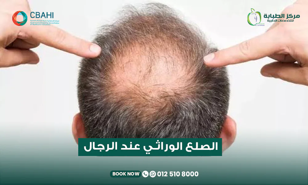 علاج الصلع الوراثي المبكر عند الرجال في مركز الطبابة