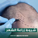 شروط زراعة الشعر