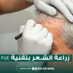 زراعة الشعر بتقنيةfue